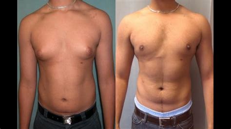 Gynecomastia .